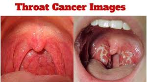 Giúp bạn tìm hiểu về bệnh ung thư vòm họng