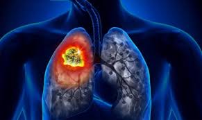 Ung thư phổi triệu chứng và phân loại